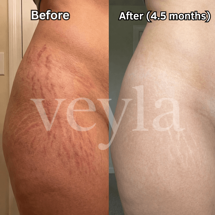 Veyla™ Clinical Acne Scar Repair Stick Veyla