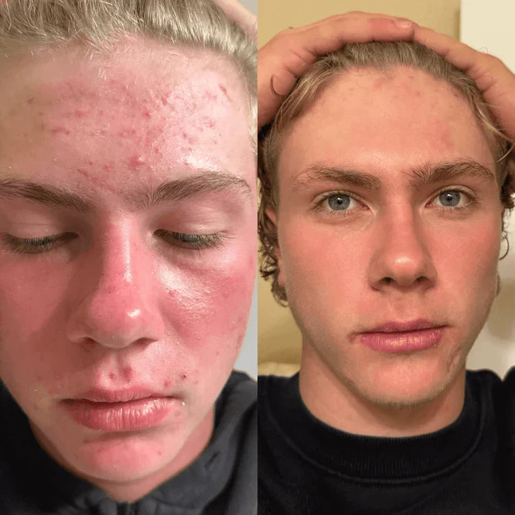 Veyla™ Clinical Acne Scar Repair Stick Veyla