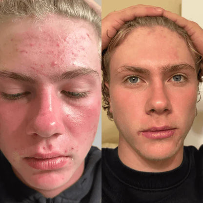 Veyla™ Clinical Acne Scar Repair Stick Veyla