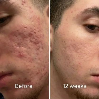 Veyla™ Clinical Acne Scar Repair Stick Veyla