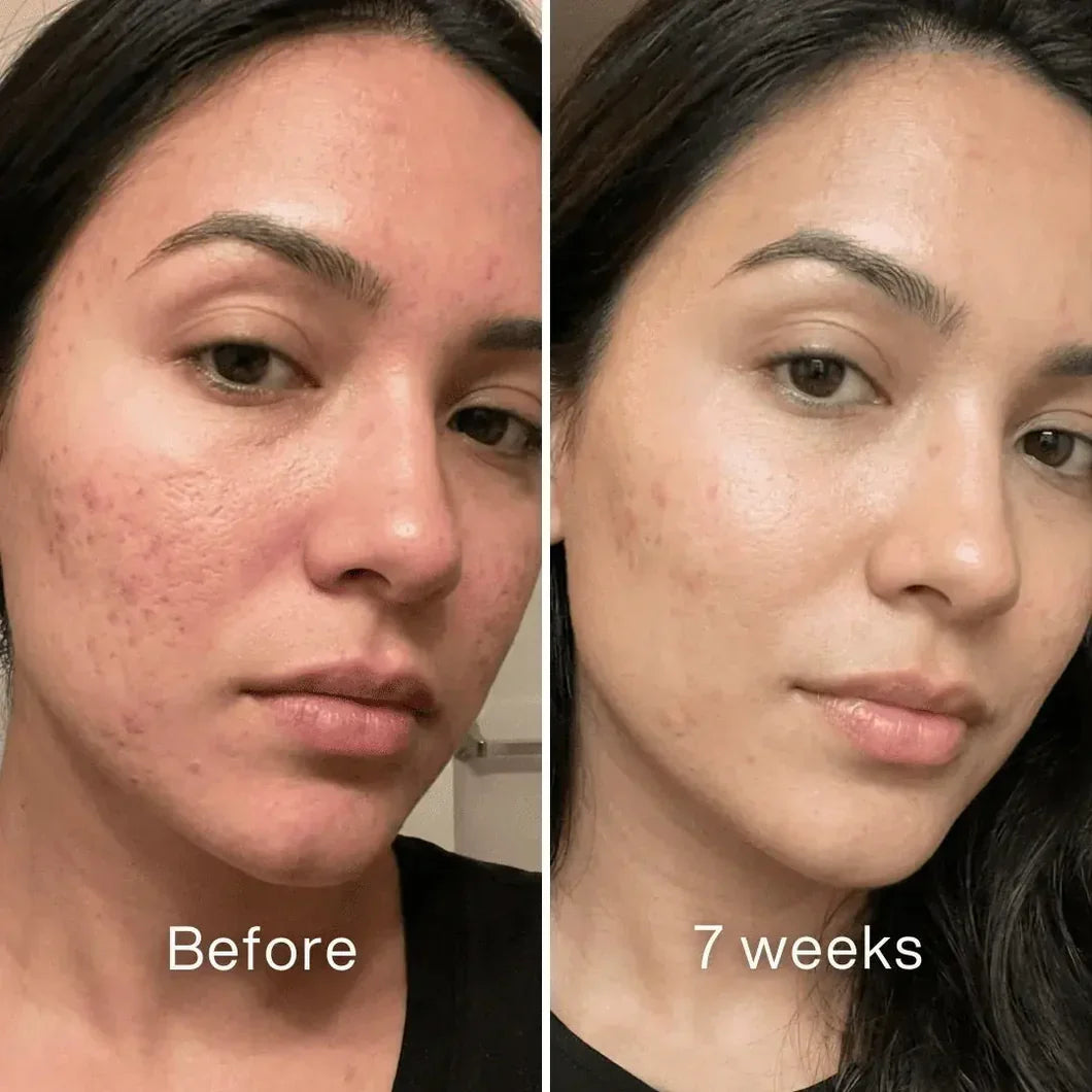 Veyla™ Clinical Acne Scar Repair Stick Veyla