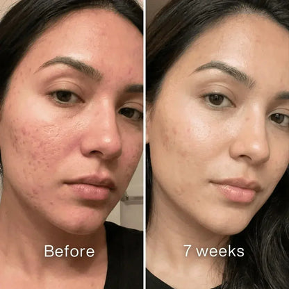 Veyla™ Clinical Acne Scar Repair Stick Veyla
